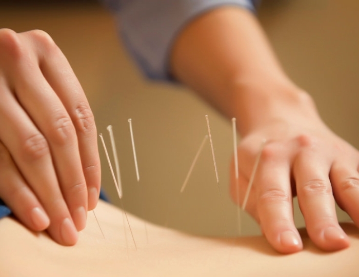 Иглорефлексотерапия - Пансионат ФЕЯ-2 SUNBEACH RESORT